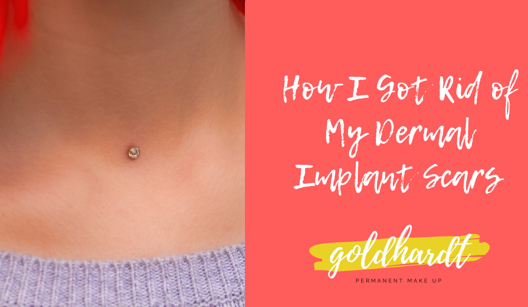 How I Got Rid of My Dermal Piercing Scars